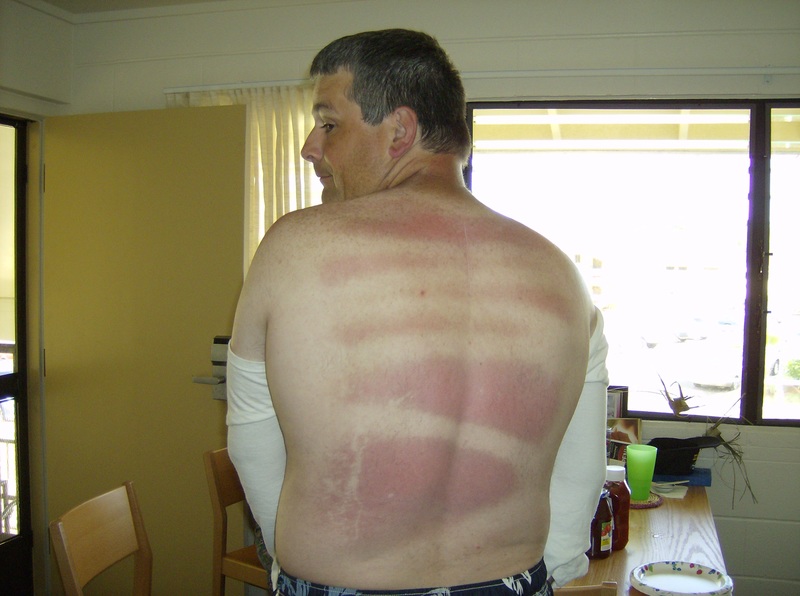 Zebra Tan - Evidence that spray sunblock really works when used