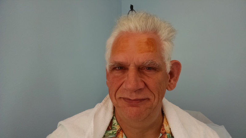 They put some germicide on my forehead where the bolts will go in.