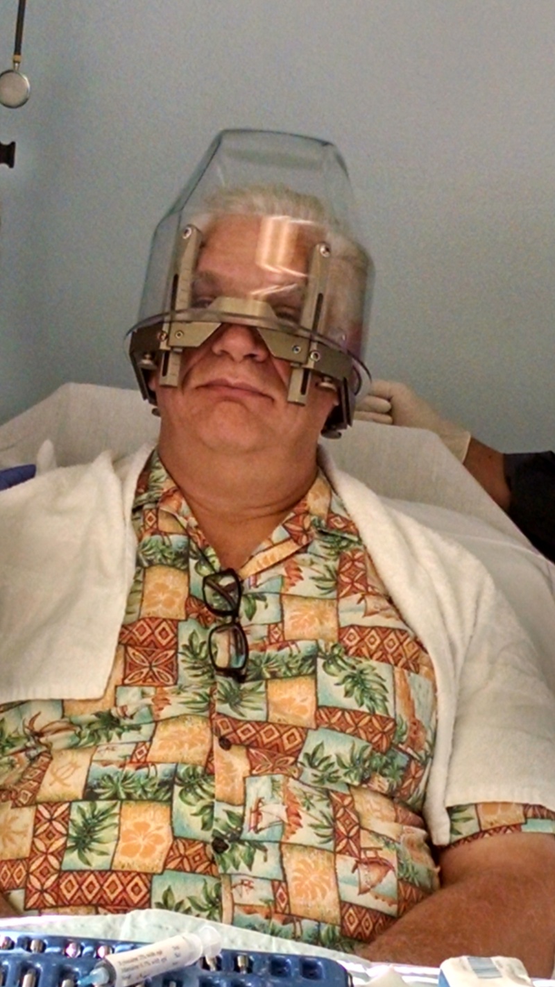 The bolts are in place. They go right through the skin and physically press against my skull. Nothing should wiggle while the gamma ray treatment is underway. We want all the gamma rays going exactly where they are needed and nowhere else. So, hold still!