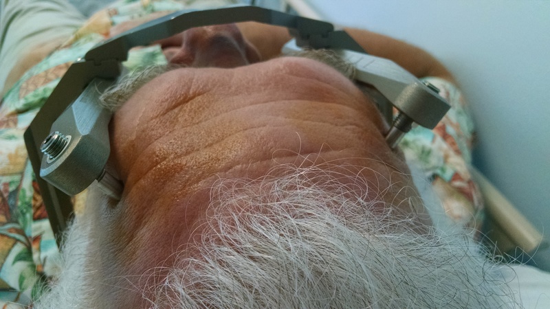 Closeup of the titanium bolts piercing my scalp.